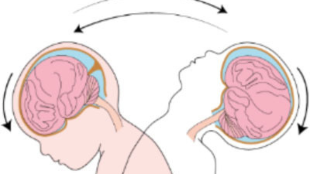 SINDROME DO BEBÊ SACUDIDO